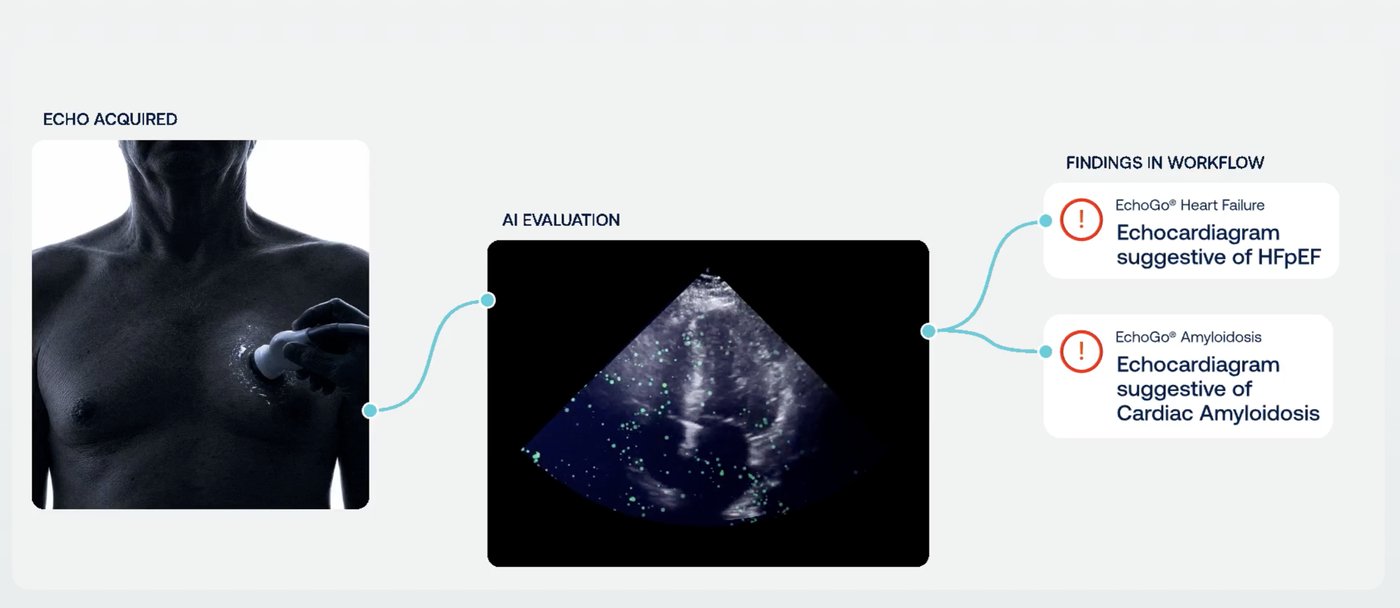 Workflow diagram: echo acquired, AI evaluation, findings in workflow